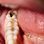 Sâu răng trong cùng có nên nhổ bỏ không? Liệu có an toàn? Sâu răng trong cùng có nên nhổ bỏ không? Liệu có an toàn?