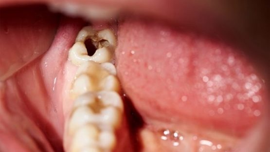 Sâu răng trong cùng có nên nhổ bỏ không? Liệu có an toàn?