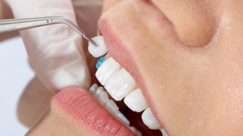 Bọc răng composite – Ưu điểm phục hình vượt trội