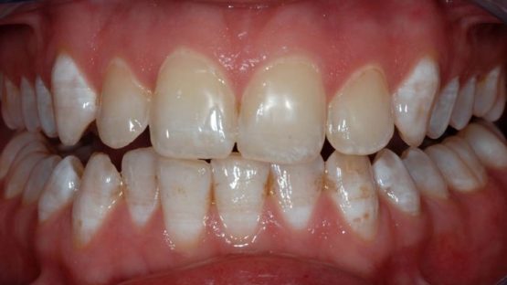 Tẩy răng không đều màu – Giải pháp tối ưu cho hàm răng trắng đẹp