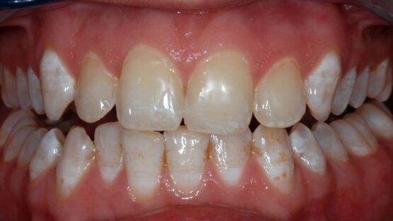 Tẩy răng không đều màu – Giải pháp tối ưu cho hàm răng trắng đẹp