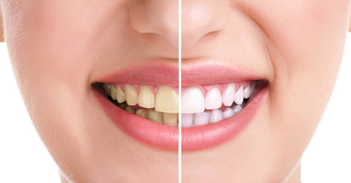 Tẩy răng vàng bằng công nghệ Brite Smile có tốt không?