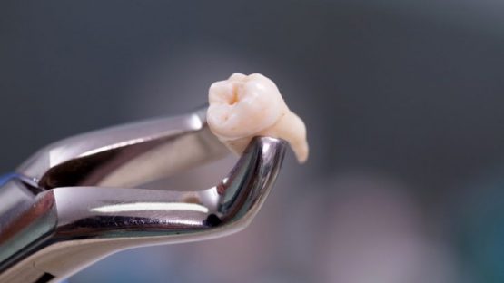 Nhổ răng khôn mọc ngầm – An toàn, không đau, hồi phục nhanh