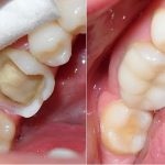 Chữa sâu răng hàm trên ở đâu an toàn và hiệu quả nhất hiện nay? Chữa sâu răng hàm trên ở đâu an toàn và hiệu quả nhất hiện nay?
