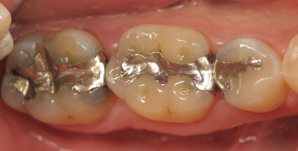 Đâu là địa chỉ trám răng nào tốt và đảm bảo chất lượng? Đâu là địa chỉ trám răng nào tốt và đảm bảo chất lượng?