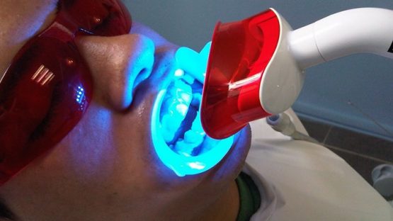 Tẩy trắng răng bằng đèn Plasma có thực sự tốt không?