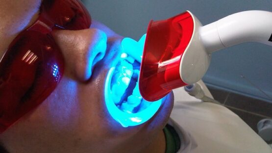 Tẩy trắng răng bằng đèn Plasma có thực sự tốt không?