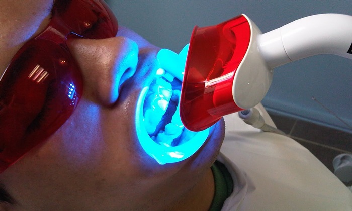 Tẩy trắng răng bằng đèn Plasma có thực sự tốt không? 1