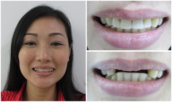 Làm răng giả cố định giá bao nhiêu? Địa chỉ trồng răng giả chất lượng