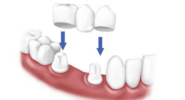 Trồng răng hàm dưới -2 Trồng răng hàm dưới -2