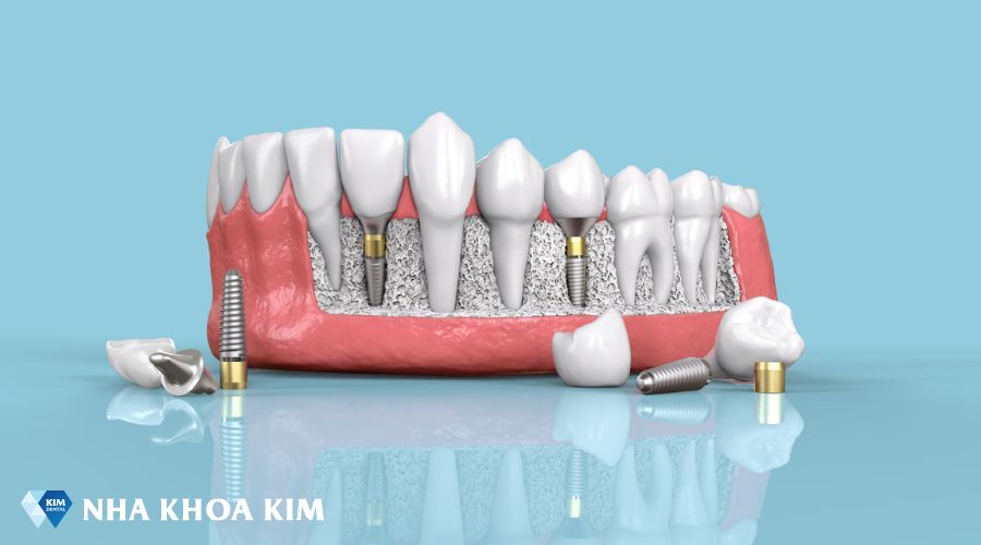 Đặc điểm chung của trụ Implant