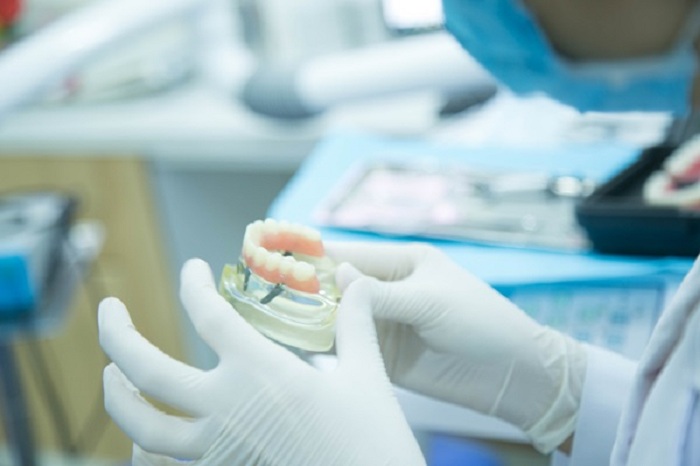 Cắm răng implant giá bao nhiêu tại Nha khoa KIM? 4