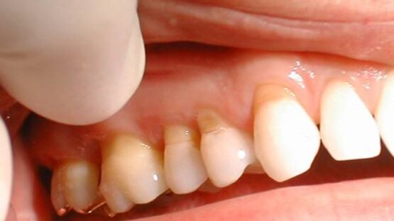 Những điều cần biết về tụt lợi và các phương pháp khắc phục tụt lợi