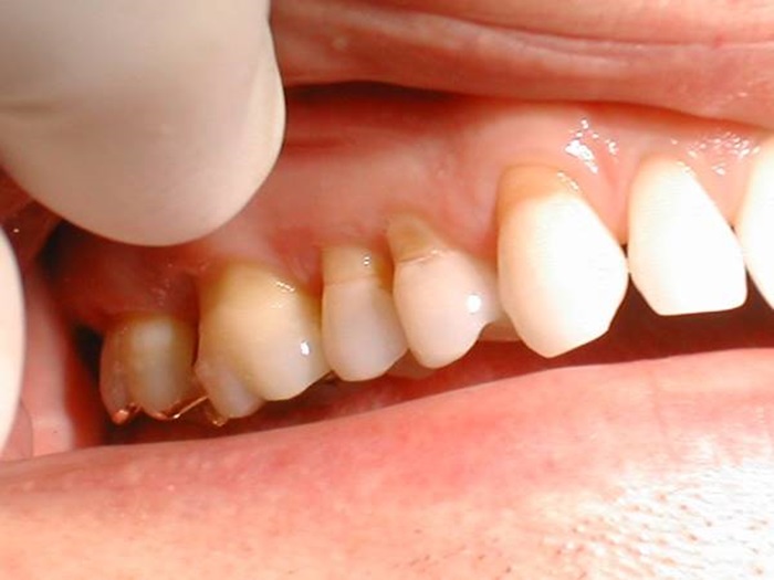 Tình trạng tụt lợi lộ chân răng