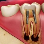 Răng bị viêm tủy - Nguyên nhân và cách điều trị an toàn, hiệu quả Răng bị viêm tủy - Nguyên nhân và cách điều trị an toàn, hiệu quả