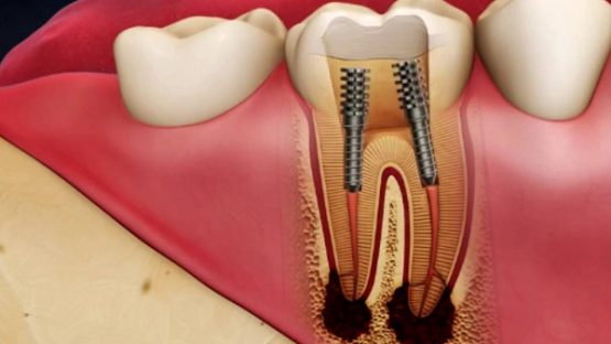 Răng bị viêm tủy – Nguyên nhân và cách điều trị an toàn, hiệu quả
