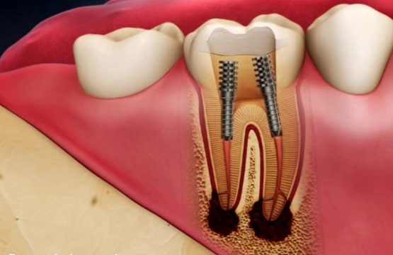 Răng bị viêm tủy – Nguyên nhân và cách điều trị an toàn, hiệu quả