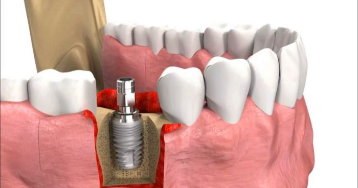 Giá làm răng implant 1