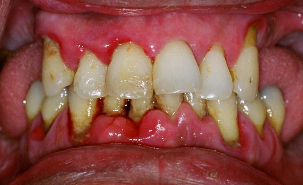 Viêm Nha Chu răng có gây nguy hiểm hay không?