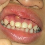 Viêm nha chu trẻ em - Nguyên nhân và cách điều trị hiệu quả Viêm nha chu trẻ em - Nguyên nhân và cách điều trị hiệu quả