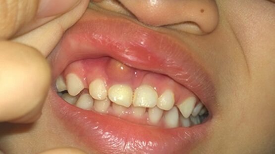 Viêm nha chu trẻ em – Nguyên nhân và cách điều trị hiệu quả
