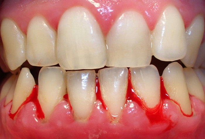 Bệnh viêm nướu răng và phương pháp điều trị triệt để 1