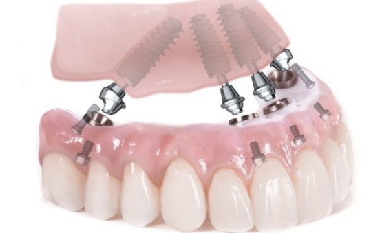 Trồng răng toàn hàm bằng kỹ thuật implant All on 4, All on 6
