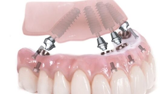 Trồng răng toàn hàm bằng kỹ thuật Implant All on 4, All on 6