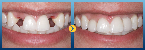 Địa chỉ trồng răng implant nào uy tín nhất -13 Địa chỉ trồng răng implant nào uy tín nhất -13