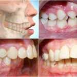 Giá phẫu thuật hàm hô bao nhiêu tiền? | Thông tin chi tiết Giá phẫu thuật hàm hô bao nhiêu tiền? | Thông tin chi tiết