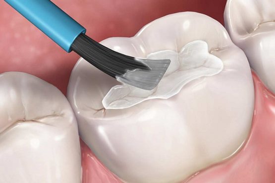 Hàn trám răng giá bao nhiêu tiền tại Nha Khoa Kim