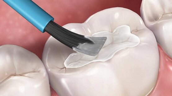 Khi nào nên thực hiện trám răng khôn? Quy trình như thế nào?