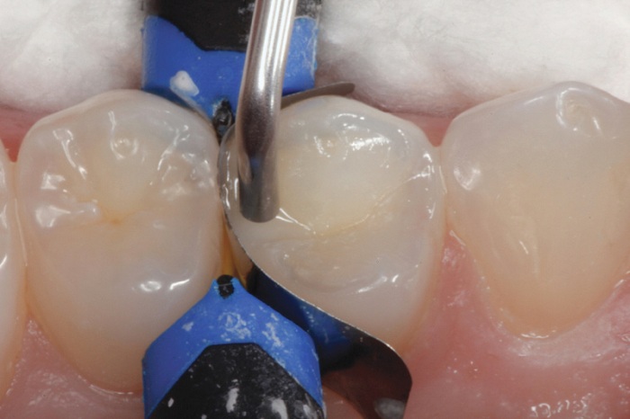 Chân răng bị đen – Nguyên nhân do đâu, làm sao loại bỏ vết đen hiệu quả? 4