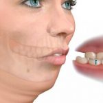 Hàm vẩu điều trị bằng cách nào? - Giải đáp Bác sĩ Chuyên Khoa Hàm vẩu điều trị bằng cách nào? - Giải đáp Bác sĩ Chuyên Khoa