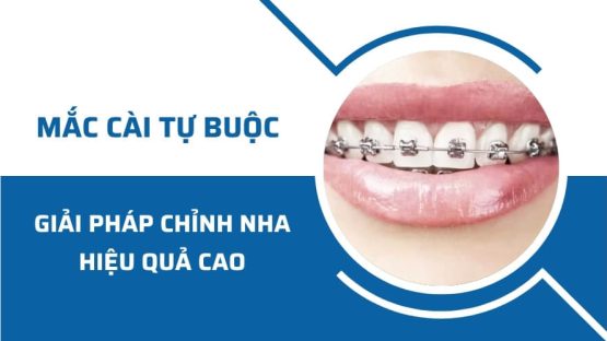 Niềng răng mắc cài tự buộc – Giải pháp chỉnh nha hiệu quả