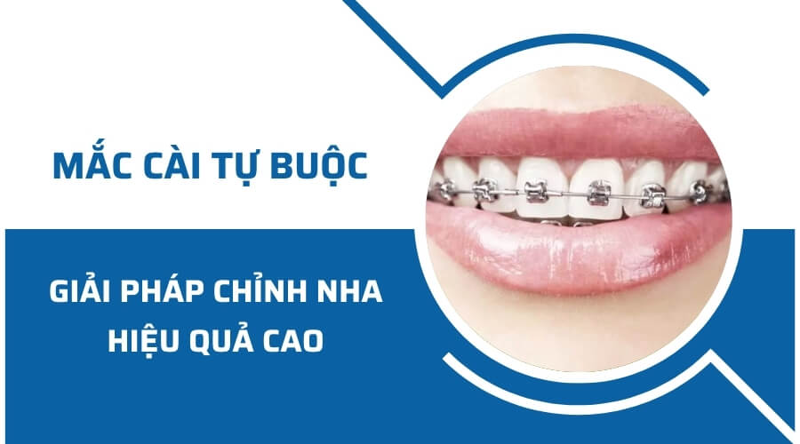 Niềng răng mắc cài tự buộc – Giải pháp chỉnh nha hiệu quả