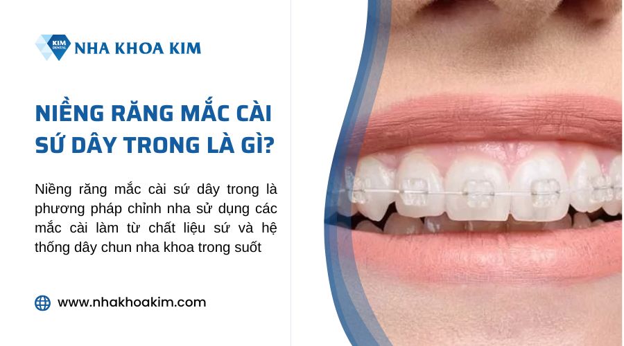 niềng răng mắc cài sứ dây trong là gì?