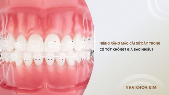 Niềng răng mắc cài sứ dây trong có tốt không? Giá bao nhiêu?