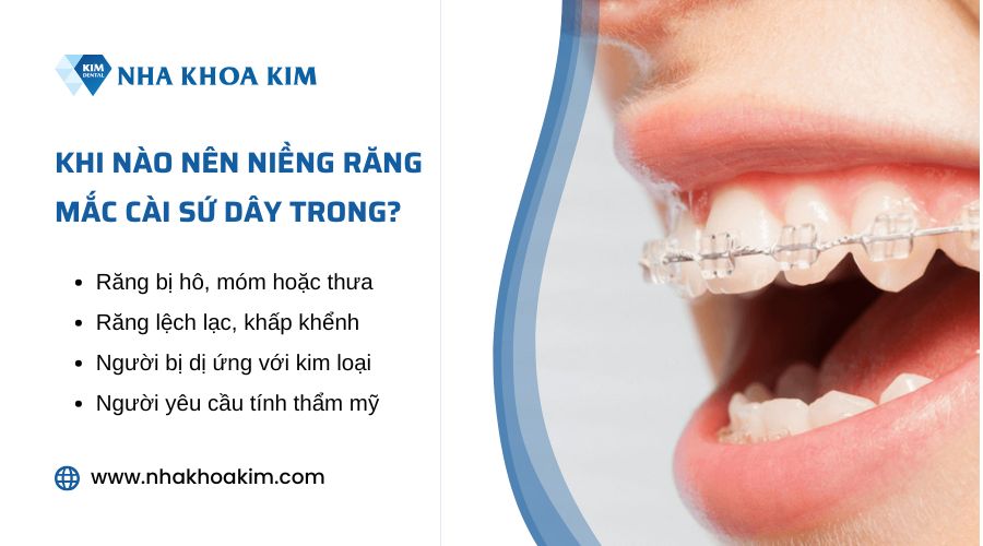 Trường hợp nào nên niềng răng sứ dây trong?