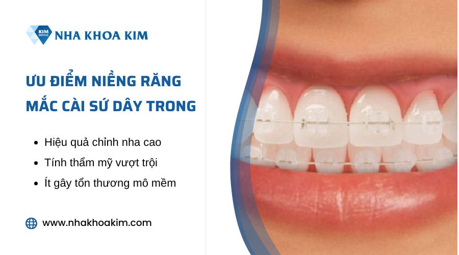 lợi ích của niềng răng mắc cài sứ