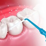 Cạo vôi răng giá bao nhiêu tiền tại Nha Khoa KIM? Cạo vôi răng giá bao nhiêu tiền tại Nha Khoa KIM?