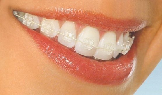 Niềng răng mắc cài pha lê – Tự tin chỉnh nha mà không sợ xấu