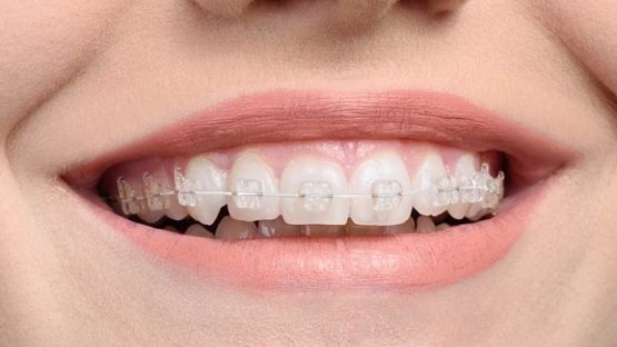Niềng răng sứ giá bao nhiêu tiền? Chi phí điều trị có đắt không?