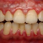 Sưng lợi do đâu và điều trị bằng cách nào tốt nhất? Sưng lợi do đâu và điều trị bằng cách nào tốt nhất?