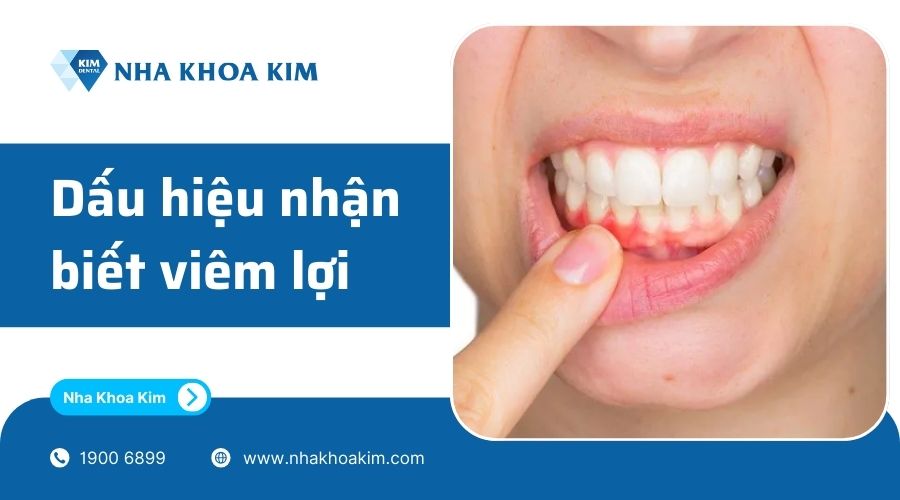 dấu hiệu nhận biết bệnh viêm nướu lợi
