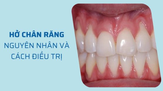 Hở chân răng – Tìm hiểu nguyên nhân và phương pháp điều trị