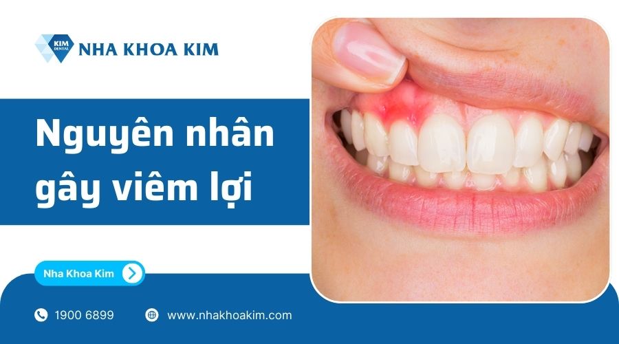 nguyên nhân gây ra viêm lợi 