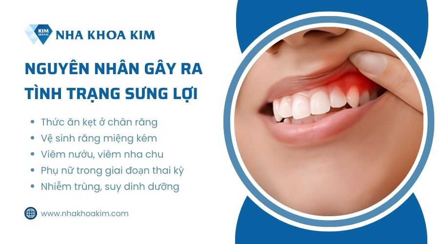 nguyên nhân gây lợi bị sưng