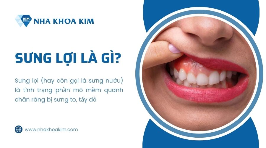 sưng lợi là gì