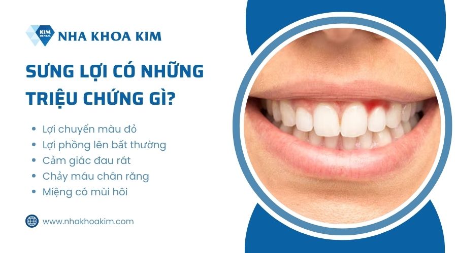 dấu hiệu triệu chứng sưng lợi